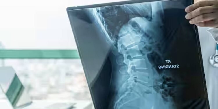 SMA रोगियों के लिए समर्पित देखभाल की आवश्यकता