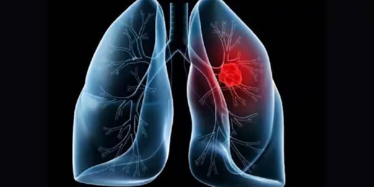 आनुवंशिक परीक्षण और फेफड़ों का कैंसर: जोखिम कारकों का आकलन