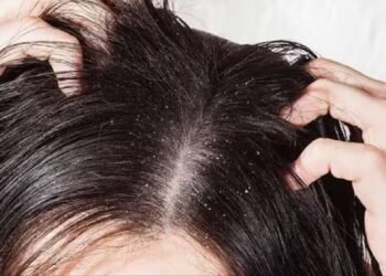 ठंड के मौसम में सूखी खोपड़ी और पपड़ी से कैसे निपटें