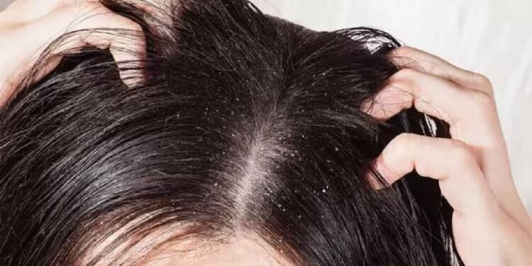 ठंड के मौसम में सूखी खोपड़ी और पपड़ी से कैसे निपटें