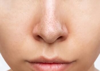 अगर आप अपने चेहरे पर ब्लैकहेड्स से परेशान हैं, तो इन टिप्स को अपनाएं, आपको राहत मिलेगी