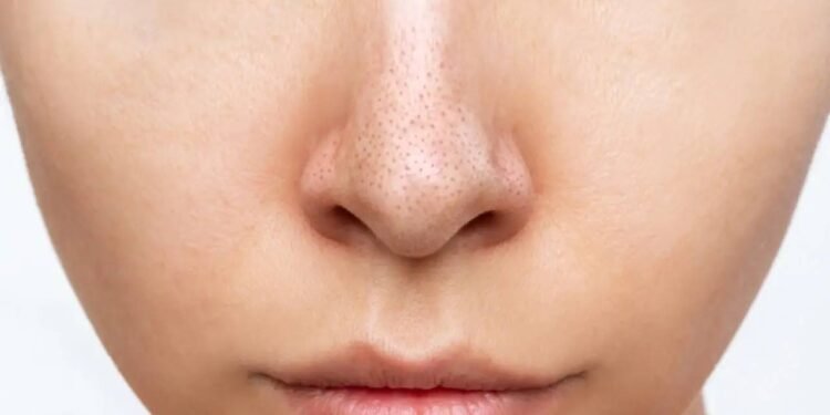 अगर आप अपने चेहरे पर ब्लैकहेड्स से परेशान हैं, तो इन टिप्स को अपनाएं, आपको राहत मिलेगी
