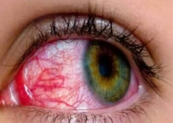 गर्मी शरीर को ही नहीं बल्कि आंखों को भी पहुंचाती है नुकसान, इन तरीकों से रखें ख्याल