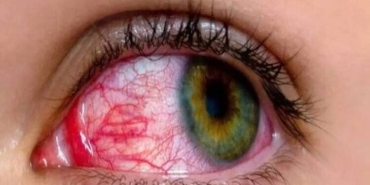 गर्मी शरीर को ही नहीं बल्कि आंखों को भी पहुंचाती है नुकसान, इन तरीकों से रखें ख्याल